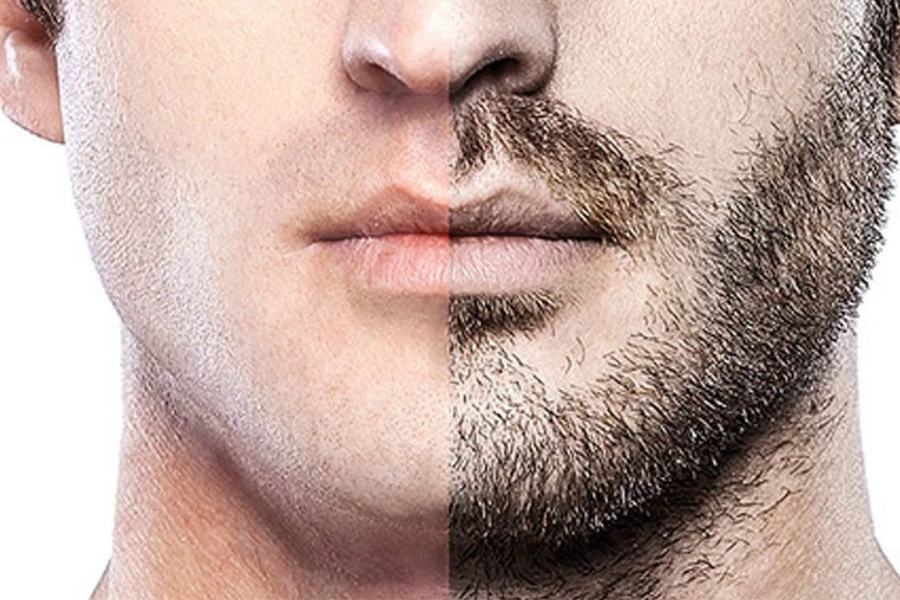 BEARD TRANSPLANT (3)