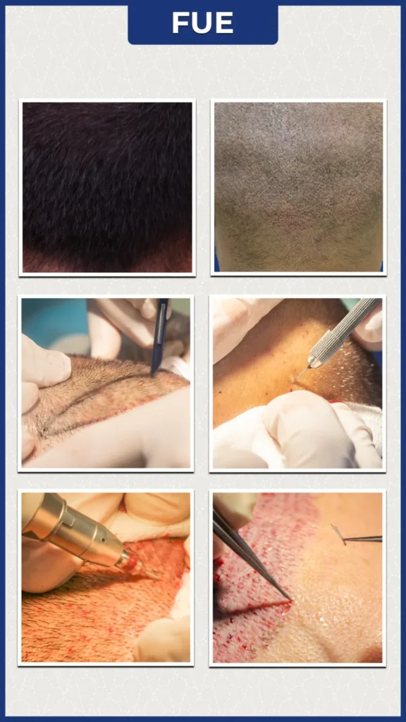 fue hair transplant