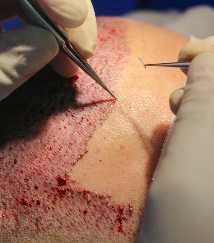 fue HAIR TRANSPLANT