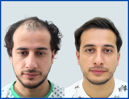 Before-After-1