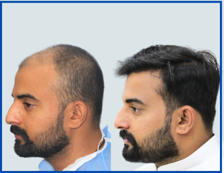 Before-After-4