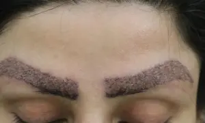 eyebrow transplant