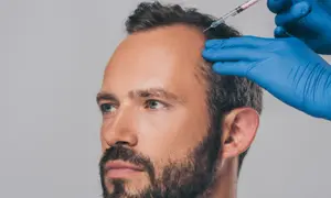 Are Beard Transplants Permanent