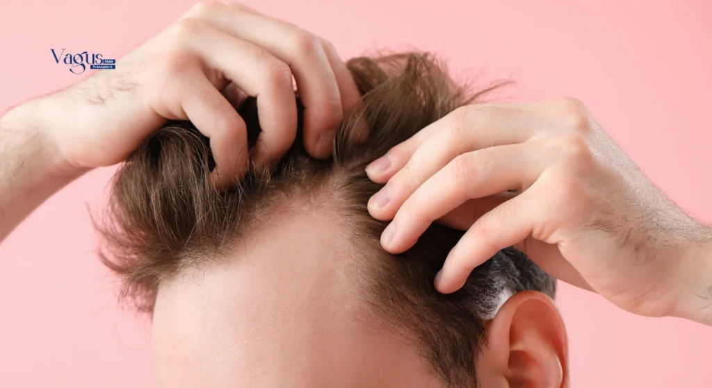 Can I Get a FUE Hair Transplant for Thinning Hair