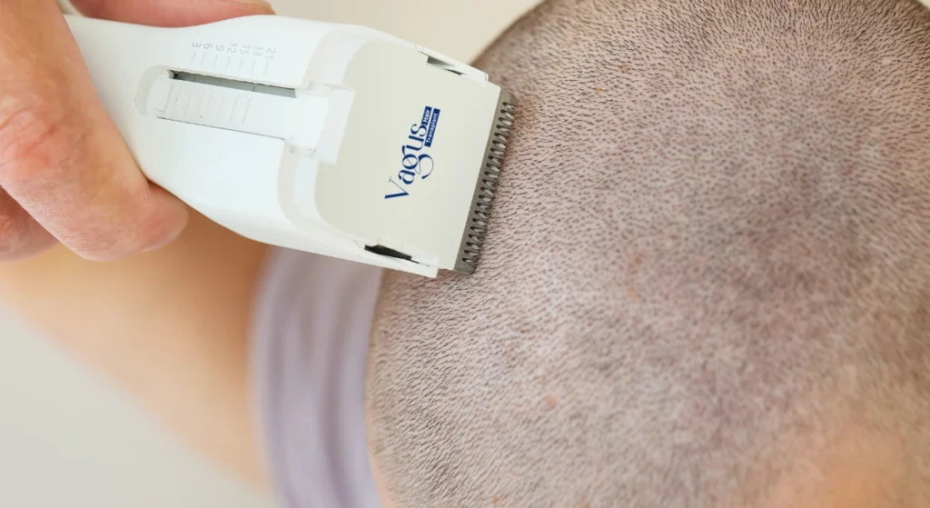 Shave Head For Hair Transplant