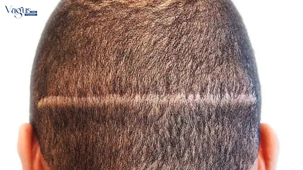 Does FUT Hair Transplant Hurt