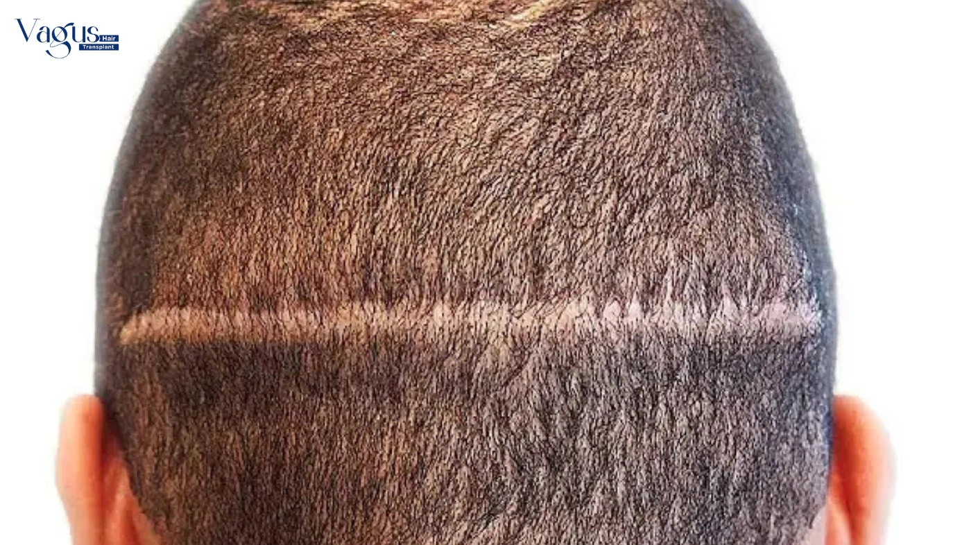 Does FUT Hair Transplant Hurt