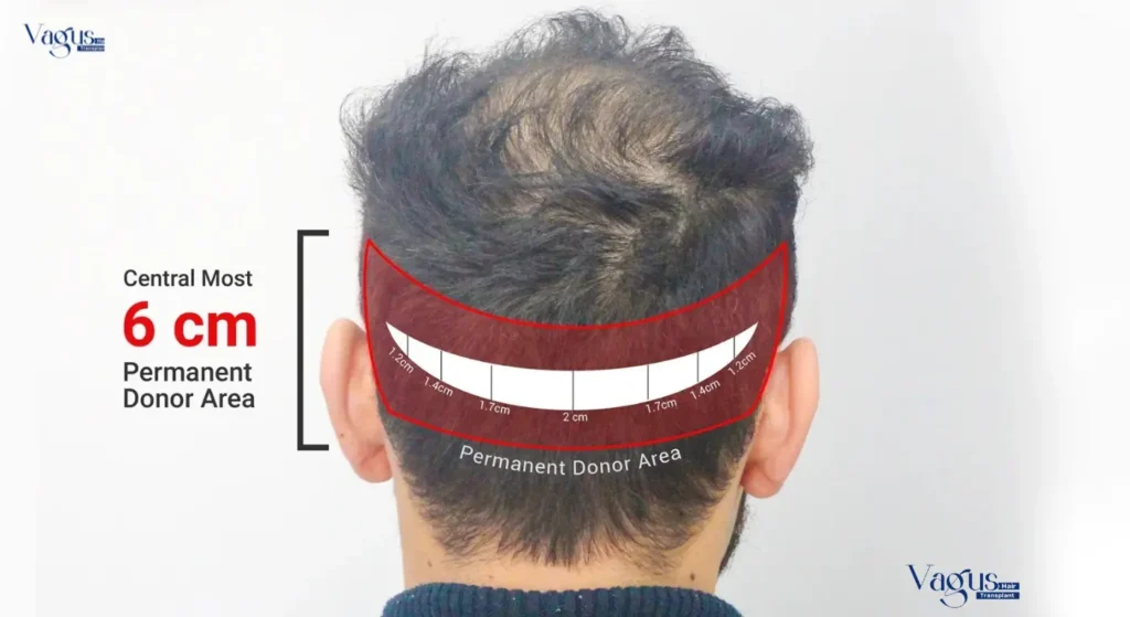 Donor Area After a Hair Transplant