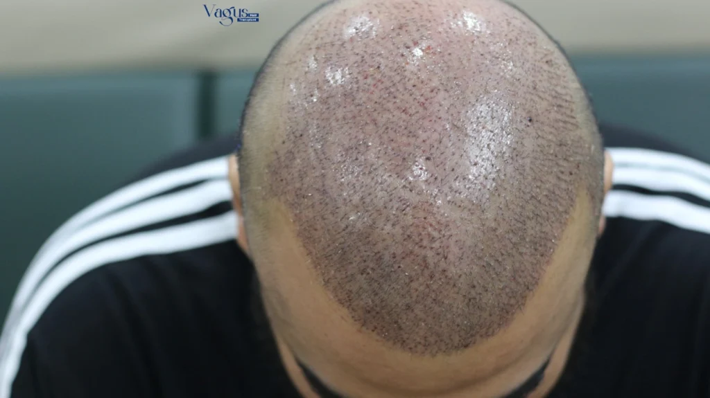 FUE vs DHI Hair Transplant