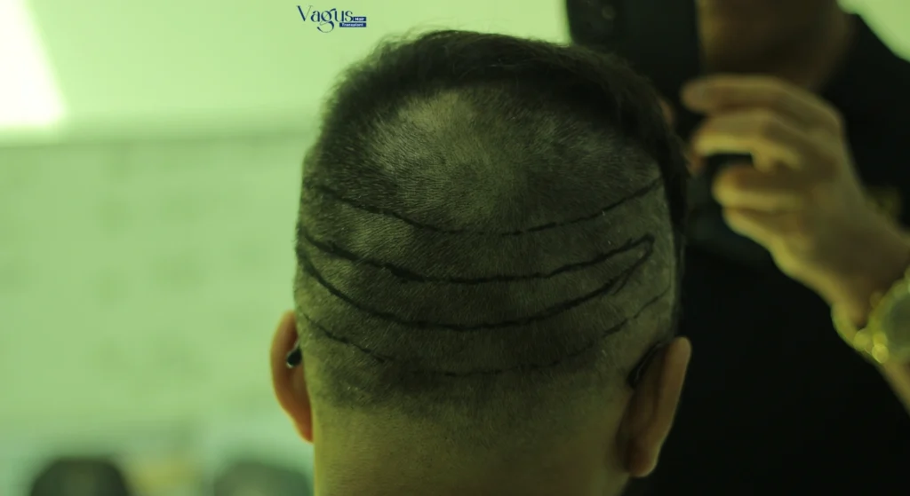 How Long Does Hair Transplant Last