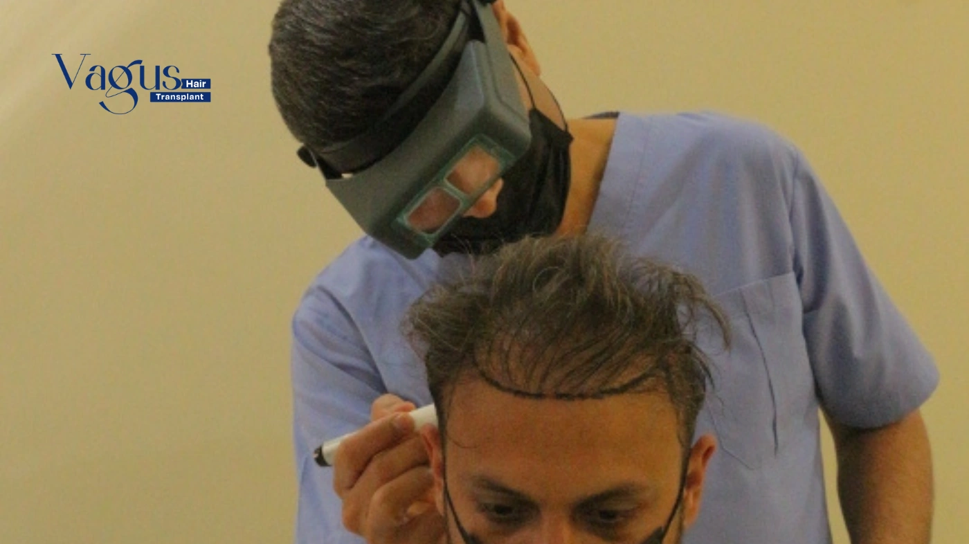 Is FUE Hair Transplant Better Than Other Hair Transplants