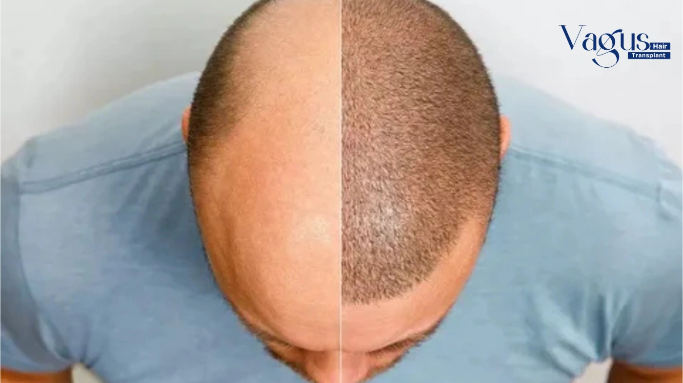 Success Rate of FUE Hair Transplant