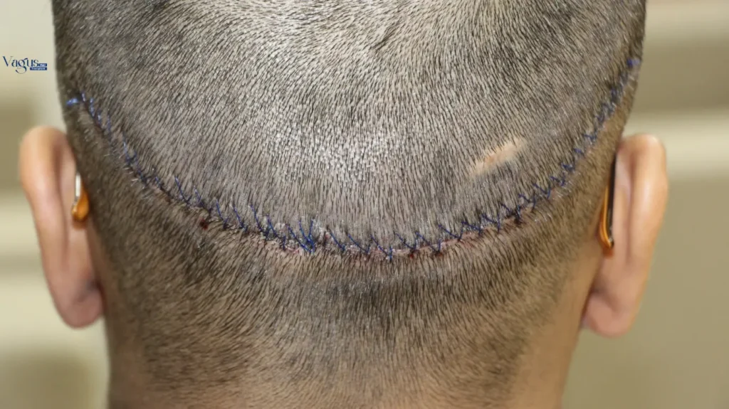 Success Rate of FUT Hair Transplant