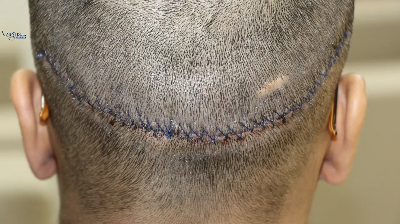 Success Rate of FUT Hair Transplant