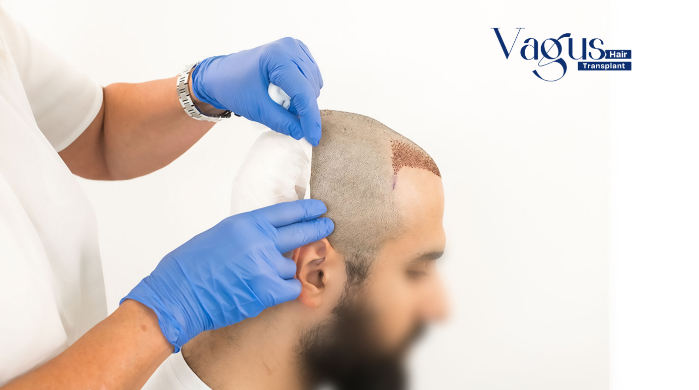 Can FUE Hair Transplant Cure Baldness