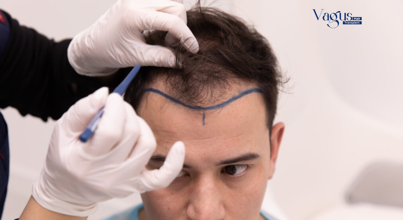 Success Rate of FUE Hair Transplant