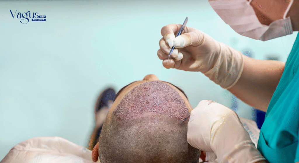 Is FUE Hair Transplant Safe