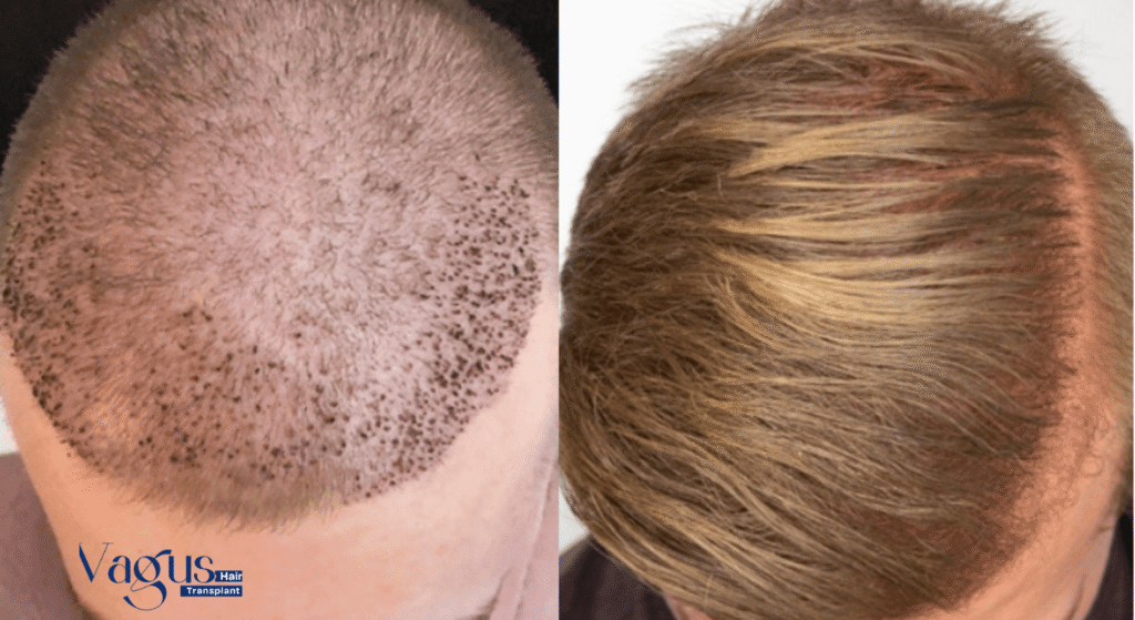 Time Takes by Transplanted Hair to Grow