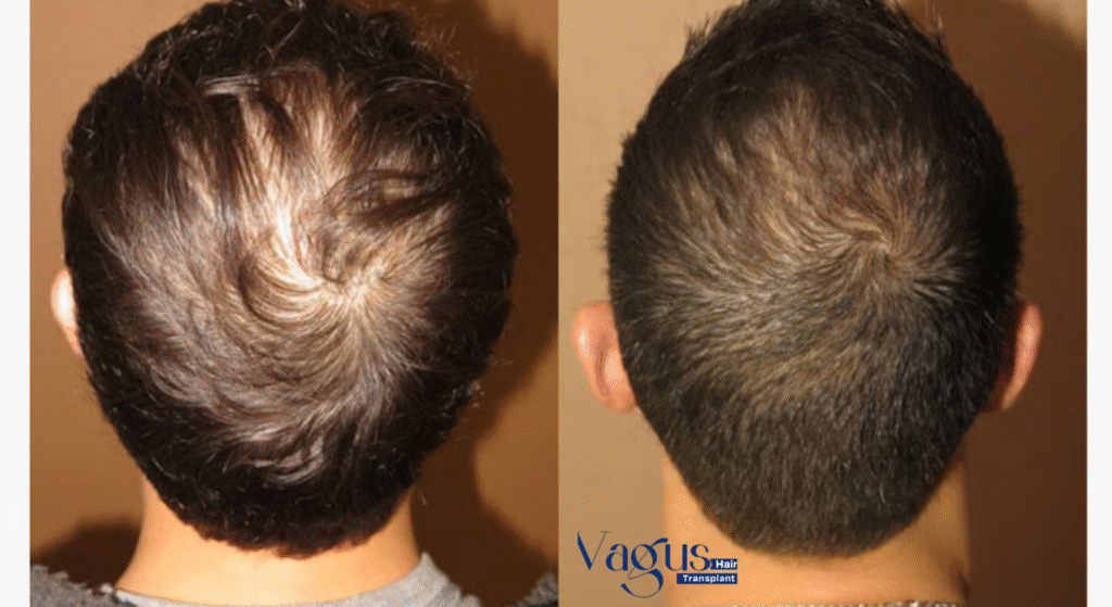 Time Takes by Transplanted Hair to Grow