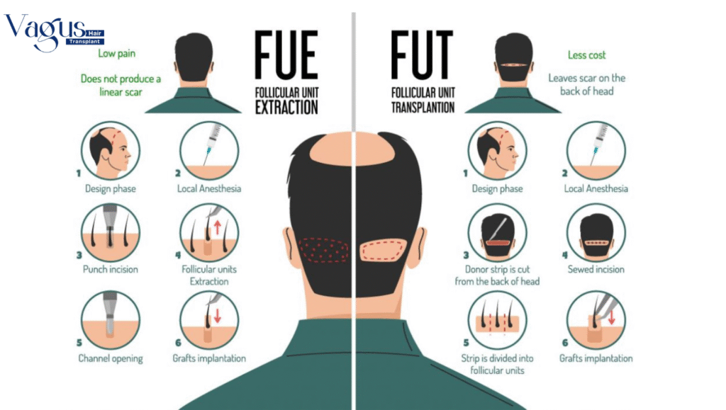 What is the Best Hair Transplant Method