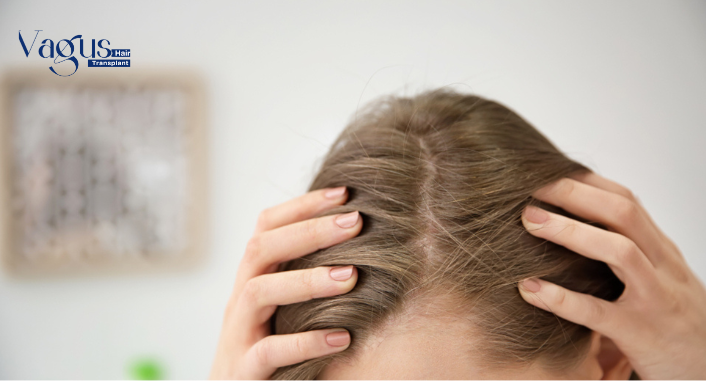 Is Female Hair Transplant Permanent