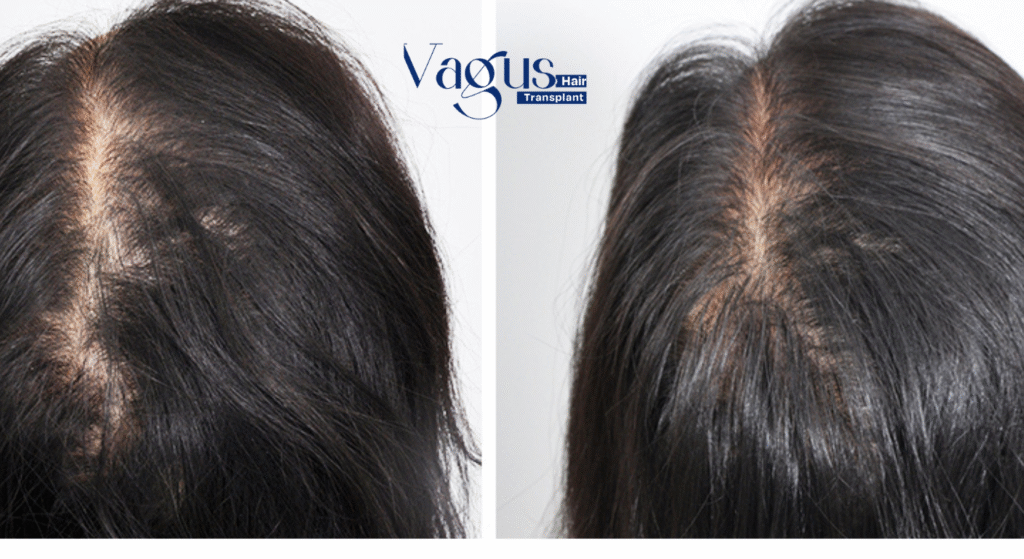 Does Hair Transplant Look Natural