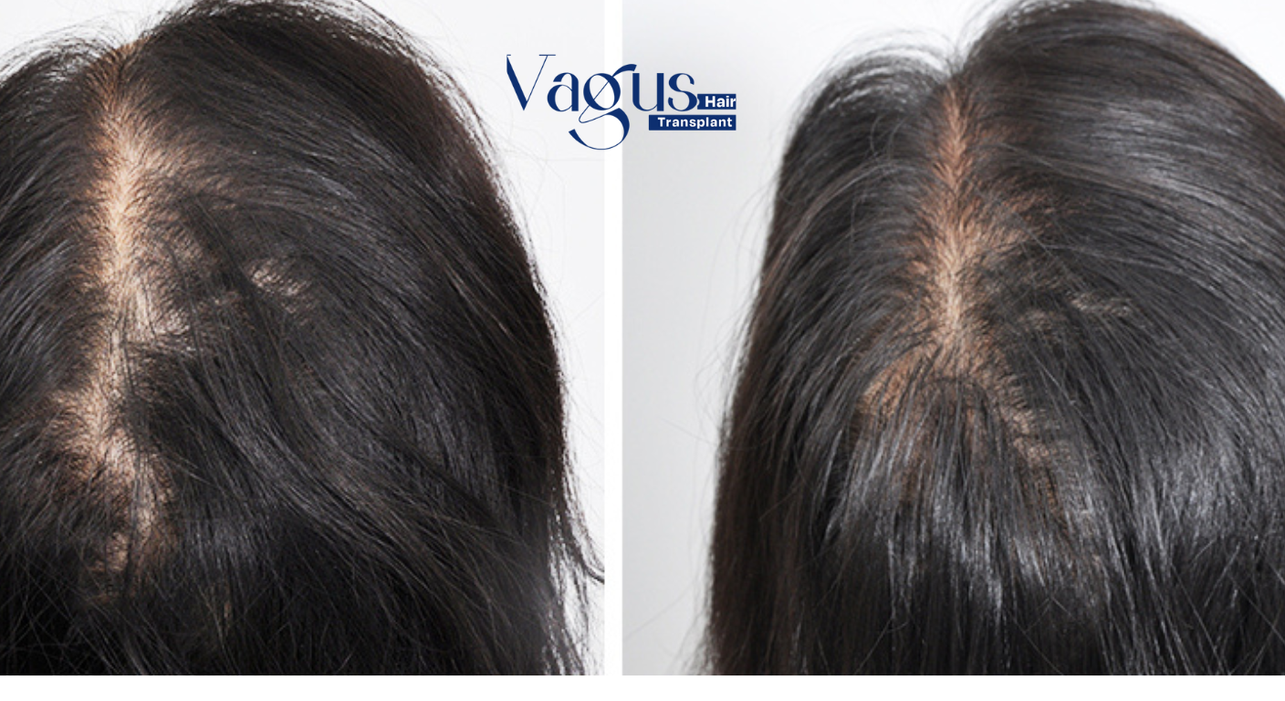 Does Hair Transplant Look Natural