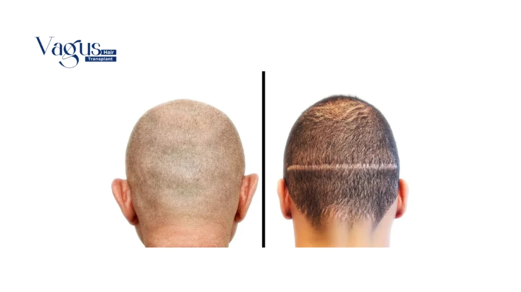 What Is FUT Hair Transplant