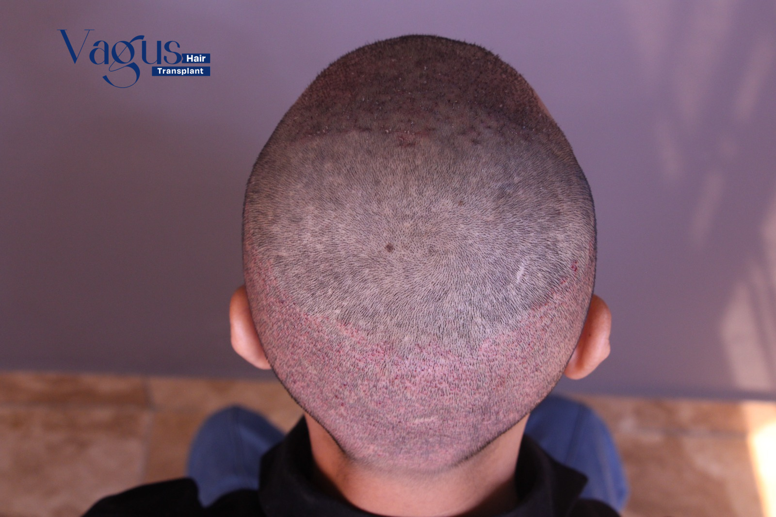 Long-Term Hair Care After FUE Transplant