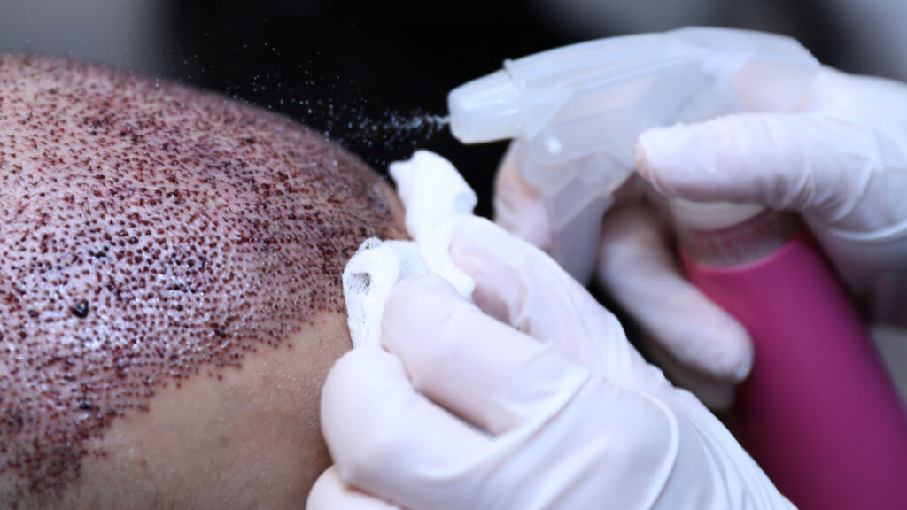 When to Wash Hair After Hair Transplant