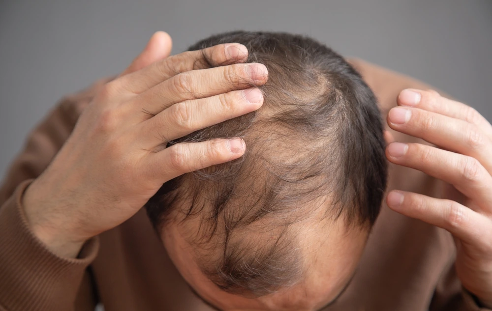 Alopecia Areata