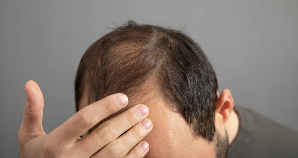 Alopecia Areata