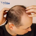 Can Stress Cause Alopecia