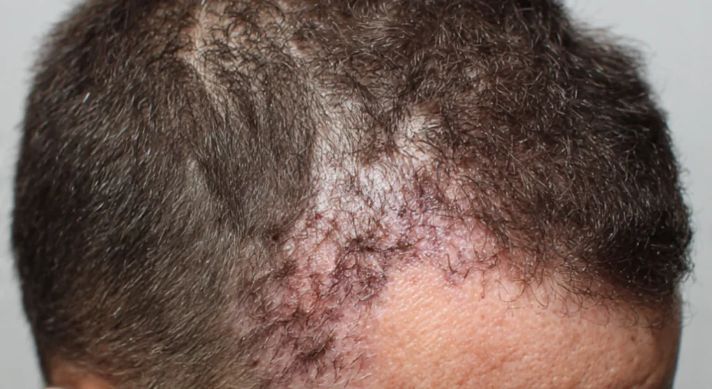 Effective Hair Transplant for Burn Victims