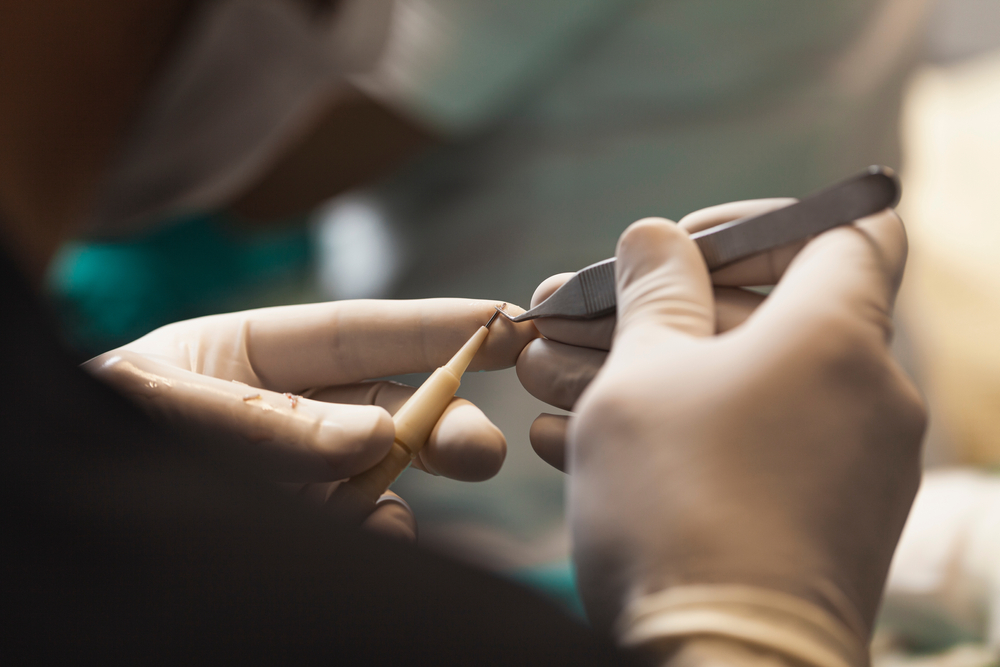 afro hair transplant in islamabad