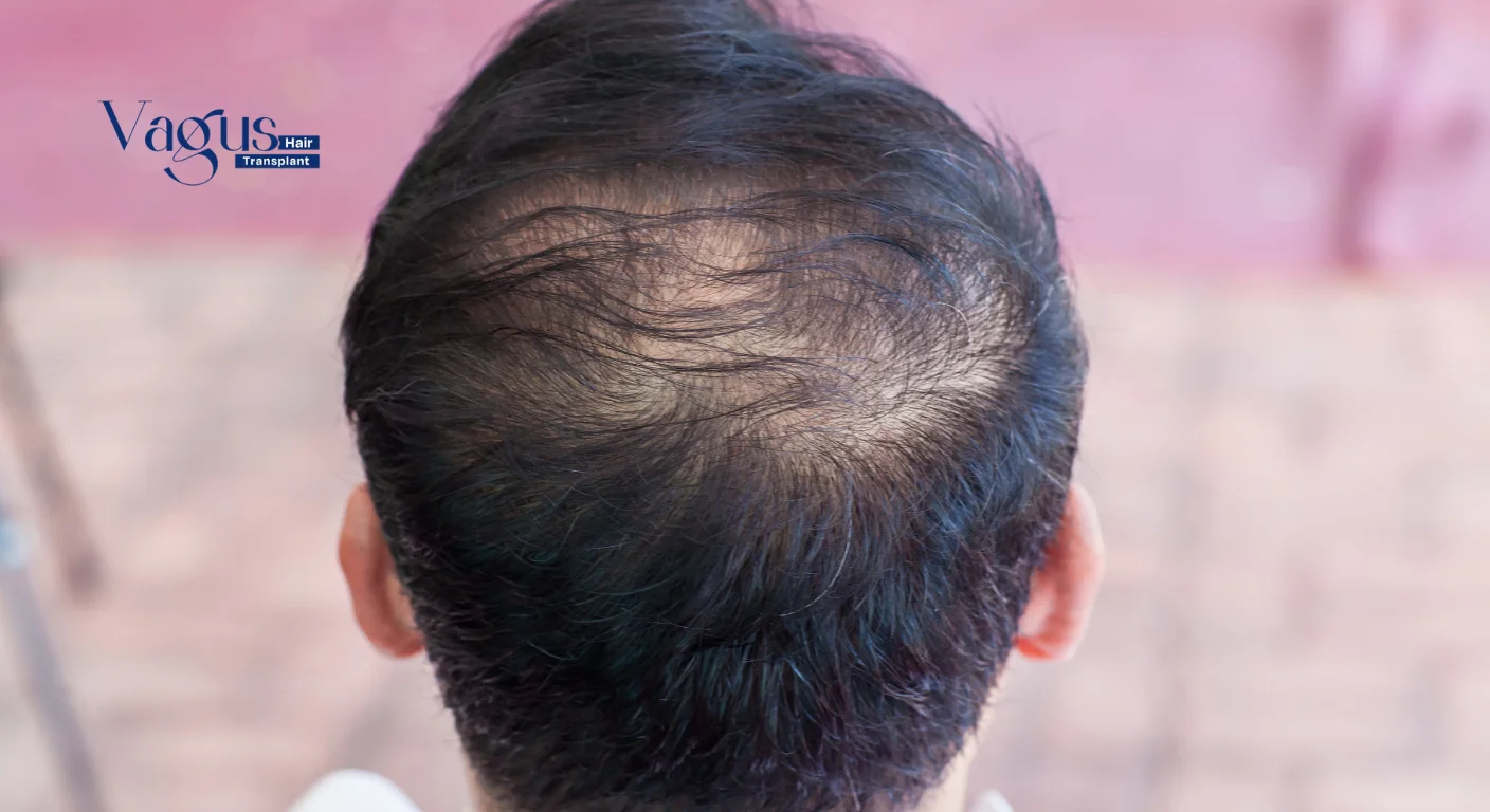 What Are the Causes of Hair Loss in Males