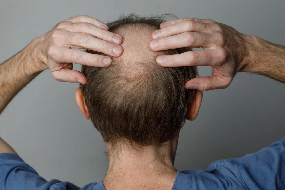 Alopecia Areata