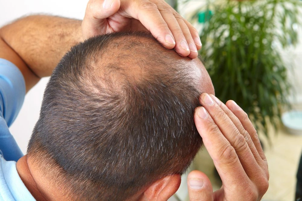 hair transplant for bald patches