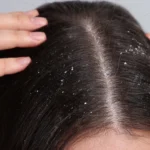 Can Dandruff Cause Hair Thinning What You Need to Know About Dandruff