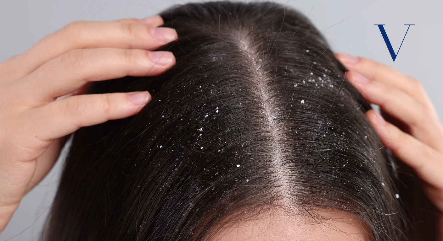 Can Dandruff Cause Hair Thinning What You Need to Know About Dandruff