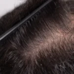 Can Dry Scalp Cause Hair Thinning Causes, Symptoms