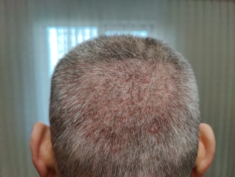 FUE Hair Transplant Recovery
