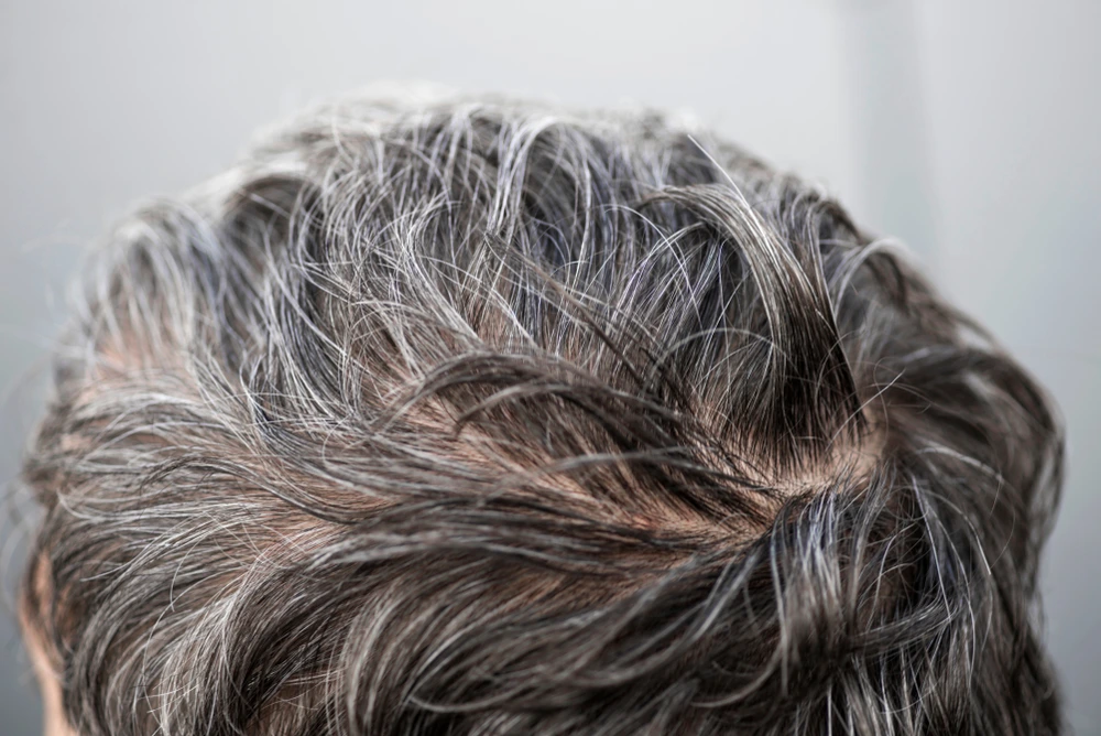 Can Hair Transplants Help with Grey Hair? 