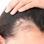 Can Hair Grow Back After Traction Alopecia Causes, Treatment, Recovery & When Hair Transplant Is Needed