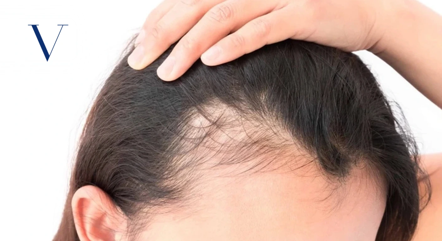 Can Hair Grow Back After Traction Alopecia Causes, Treatment, Recovery & When Hair Transplant Is Needed