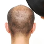 Do Hats Cause Hair Thinning
