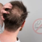 Does Smoking Cause Hair Thinning Understand the Connection and Impact on Hair