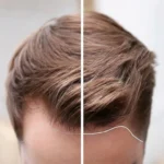 How to Regrow Hair on Hairline Naturally