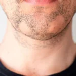 Is Alopecia Areata Barbae Permanent or Will Beard Hair Grow Back