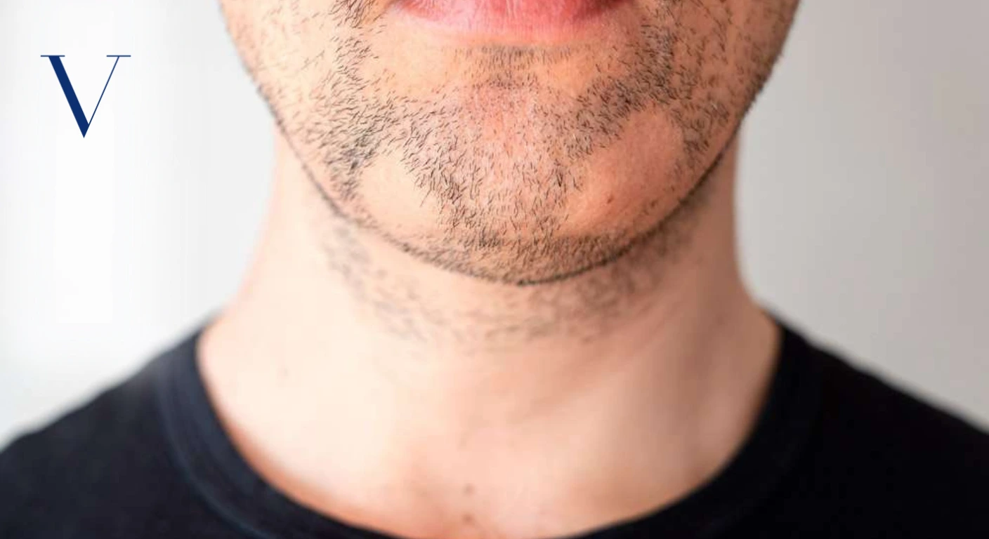 Is Alopecia Areata Barbae Permanent or Will Beard Hair Grow Back